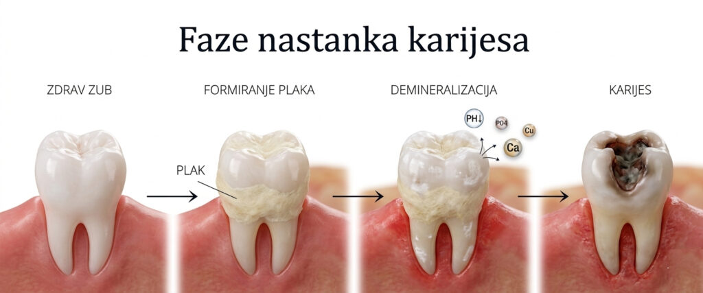 Faze nastanka karijesa Faze nastanka karijesa